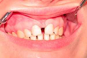 separación de los dientes
