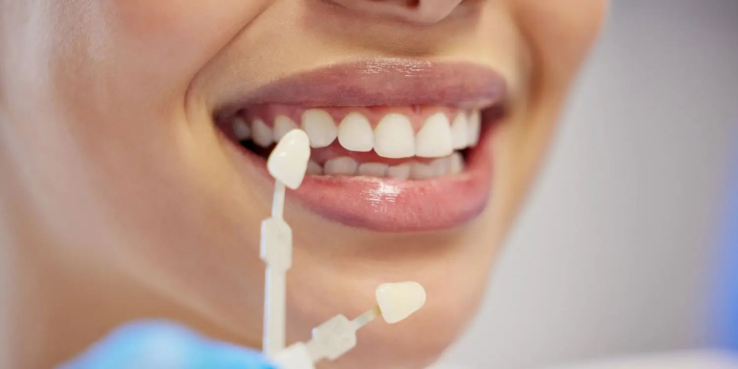 ¿Cuánto dura un blanqueamiento dental?
