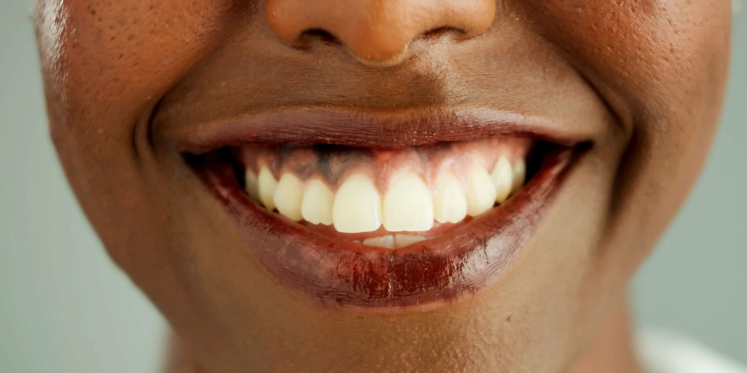 Encías oscuras: causas, tratamiento y prevención