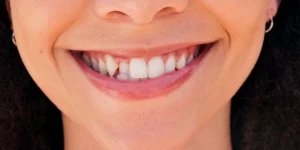 Apiñamiento dental: causas y soluciones